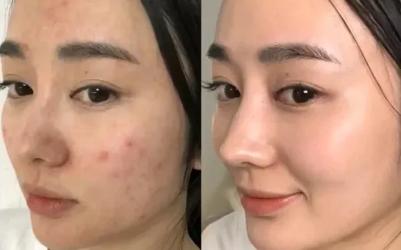 ĐIỀU TRỊ MỤN CHUYÊN SÂU