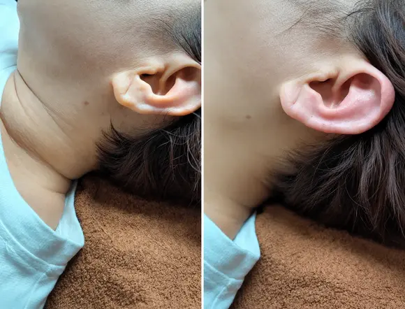 CẤY TAI PHONG THỦY – ĐIỂM NHẤN THẨM MỸ THEO QUAN NIỆM TÀI LỘC