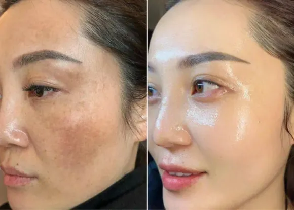 ĐIỀU TRỊ NÁM – GIẢI PHÁP HỖ TRỢ CẢI THIỆN SẮC TỐ, CHO LÀN DA ĐỀU MÀU