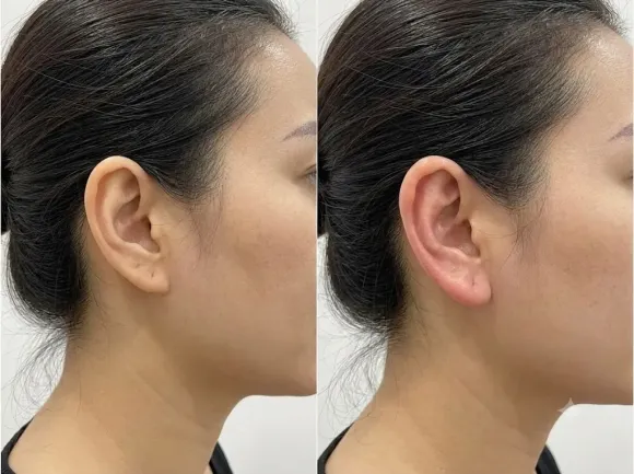 Cấy Tai Phong Thủy Được Quan Tâm Trở Lại: Những Điều Người Mới Tìm Hiểu Nên Biết